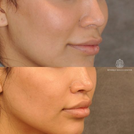 Beverly Hills Center Female Patient Before and After Modified Upper Lip Lift