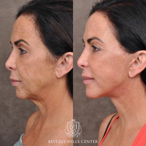 Beverly Hills Center Female Patient Before and After AuraLyft with Buccal Fat Transfer