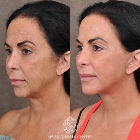 Beverly Hills Center Female Patient Before and After AuraLyft with Buccal Fat Transfer