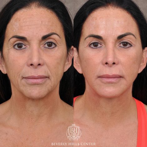 Beverly Hills Center Female Patient Before and After AuraLyft with Buccal Fat Transfer