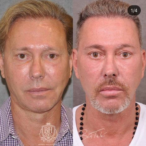 Beverly Hills Center Male Patient Before and After Profound MicroLift with Tri-L Treatment