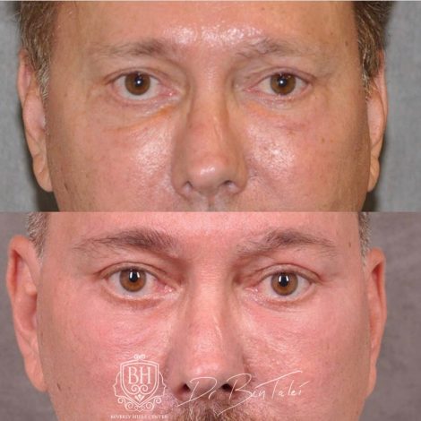 Beverly Hills Center Male Patient Before and After Profound MicroLift with Tri-L Treatment