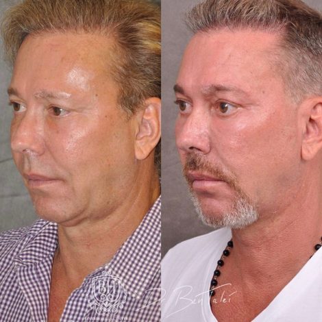 Beverly Hills Center Male Patient Before and After Profound MicroLift with Tri-L Treatment