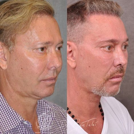 Beverly Hills Center Male Patient Before and After Profound MicroLift with Tri-L Treatment