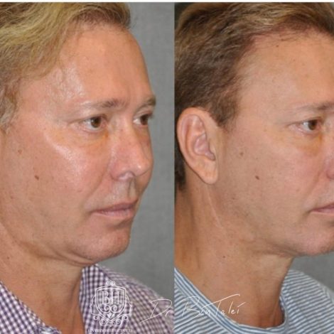 Beverly Hills Center Male Patient Before and After Profound MicroLift with Tri-L Treatment