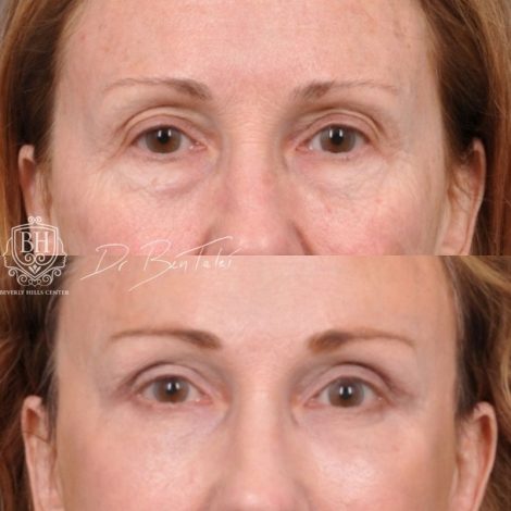 Beverly Hills Center Female Patient Before and After AuraLyft with Upper Blepharoplasty Procedure