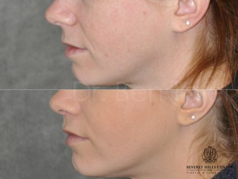 Beverly Hills Center Female Patient Before and After Modified Upper Lip Lift