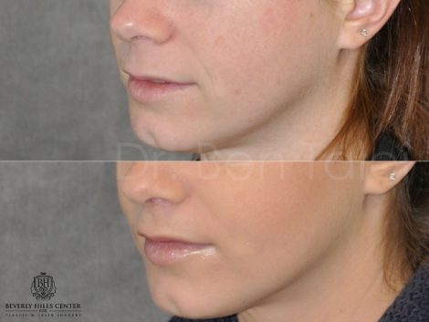Beverly Hills Center Female Patient Before and After Modified Upper Lip Lift