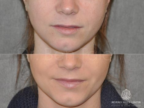 Beverly Hills Center Female Patient Before and After Modified Upper Lip Lift