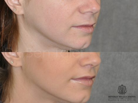 Beverly Hills Center Female Patient Before and After Modified Upper Lip Lift