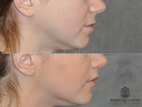 Beverly Hills Center Female Patient Before and After Modified Upper Lip Lift