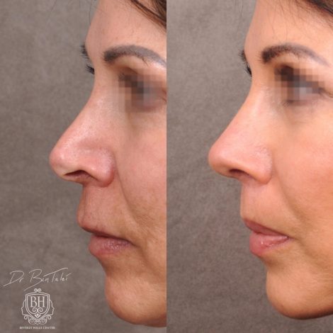 Beverly Hills Center Female Patient Before and After AuraLyft Procedure and Revision Rhinoplasty