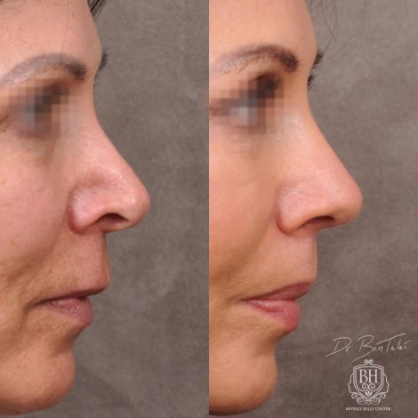 Beverly Hills Center Female Patient Before and After AuraLyft Procedure and Revision Rhinoplasty