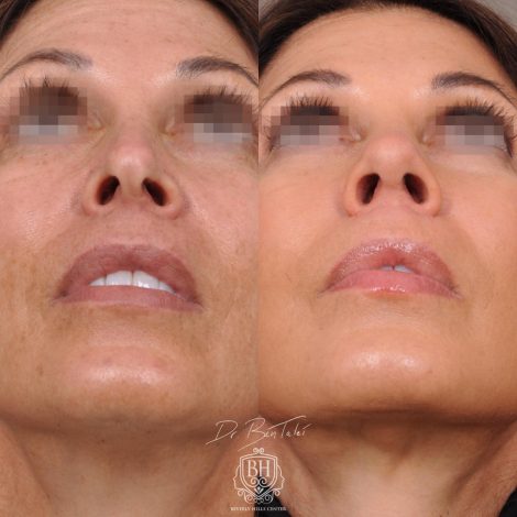 Beverly Hills Center Female Patient Before and After AuraLyft Procedure and Revision Rhinoplasty