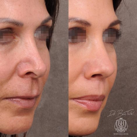 Beverly Hills Center Female Patient Before and After AuraLyft Procedure and Revision Rhinoplasty