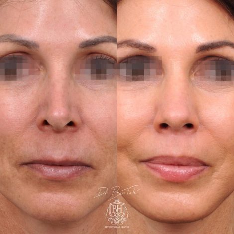 Beverly Hills Center Female Patient Before and After AuraLyft Procedure and Revision Rhinoplasty