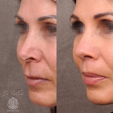 Beverly Hills Center Female Patient Before and After AuraLyft Procedure and Revision Rhinoplasty