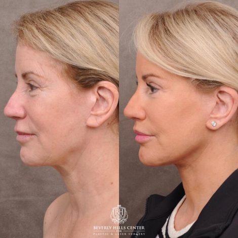 Beverly Hills Center Female Patient Before and After AuraLyft, Upper Bleph with Fat Repositioning, Lip Filler Romoval, Deep Plane Lip Lift
