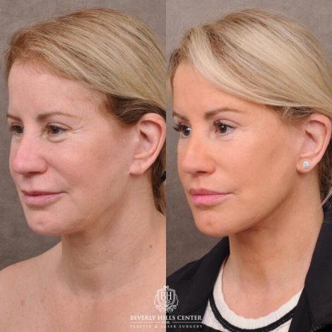 Beverly Hills Center Female Patient Before and After AuraLyft, Upper Bleph with Fat Repositioning, Lip Filler Romoval, Deep Plane Lip Lift
