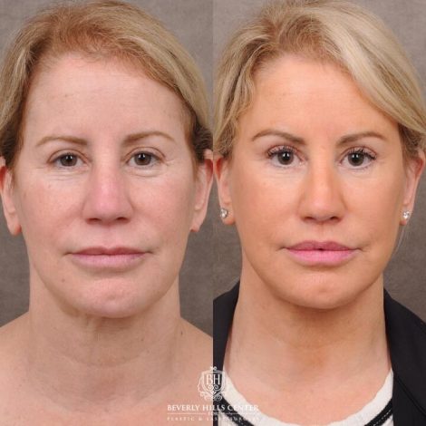 Beverly Hills Center Female Patient Before and After AuraLyft, Upper Bleph with Fat Repositioning, Lip Filler Romoval, Deep Plane Lip Lift