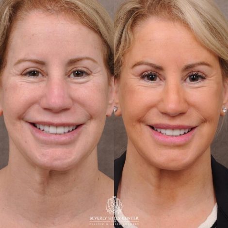 Beverly Hills Center Female Patient Before and After AuraLyft, Upper Bleph with Fat Repositioning, Lip Filler Romoval, Deep Plane Lip Lift