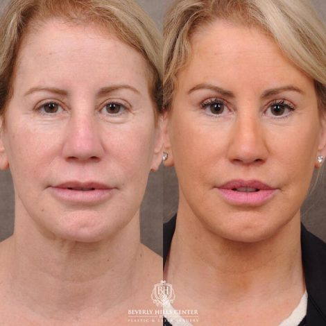 Beverly Hills Center Female Patient Before and After AuraLyft, Upper Bleph with Fat Repositioning, Lip Filler Romoval, Deep Plane Lip Lift