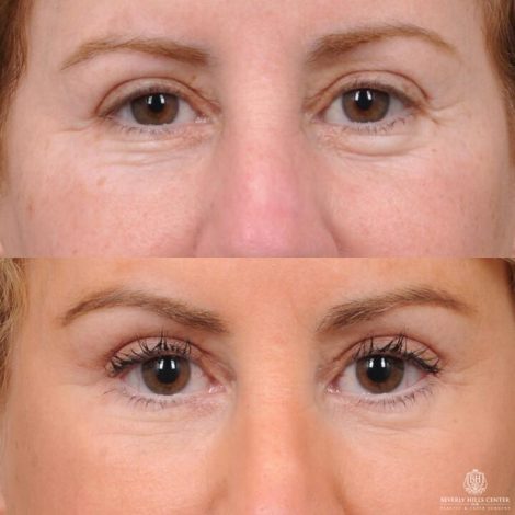 Beverly Hills Center Female Patient Before and After AuraLyft, Upper Bleph with Fat Repositioning, Lip Filler Romoval, Deep Plane Lip Lift