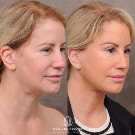 Beverly Hills Center Female Patient Before and After AuraLyft, Upper Bleph with Fat Repositioning, Lip Filler Romoval, Deep Plane Lip Lift