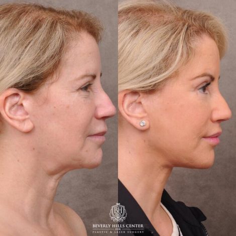 Beverly Hills Center Female Patient Before and After AuraLyft, Upper Bleph with Fat Repositioning, Lip Filler Romoval, Deep Plane Lip Lift
