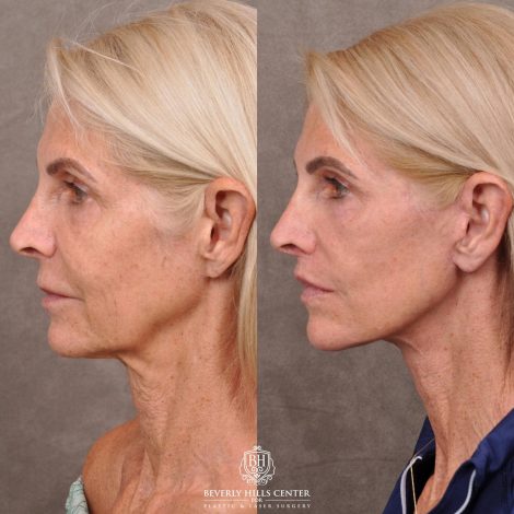 Beverly Hills Center Female Patient Before and After AuraLyft