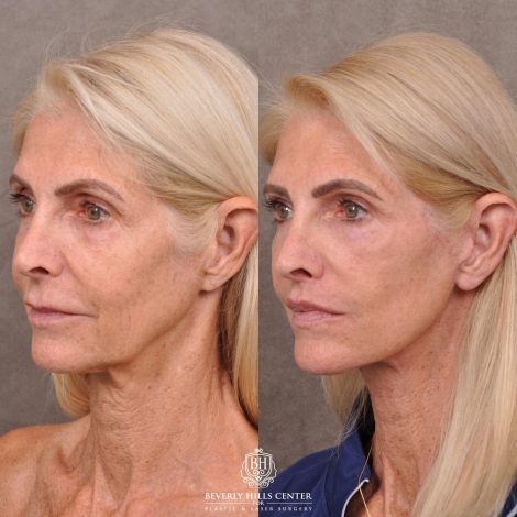 Beverly Hills Center Female Patient Before and After AuraLyft