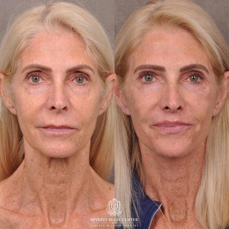 Beverly Hills Center Female Patient Before and After AuraLyft