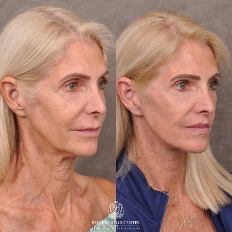 Beverly Hills Center Female Patient Before and After AuraLyft