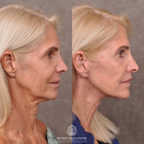 Beverly Hills Center Female Patient Before and After AuraLyft
