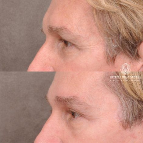 Beverly Hills Center Female Patient Before and After Brow Lift