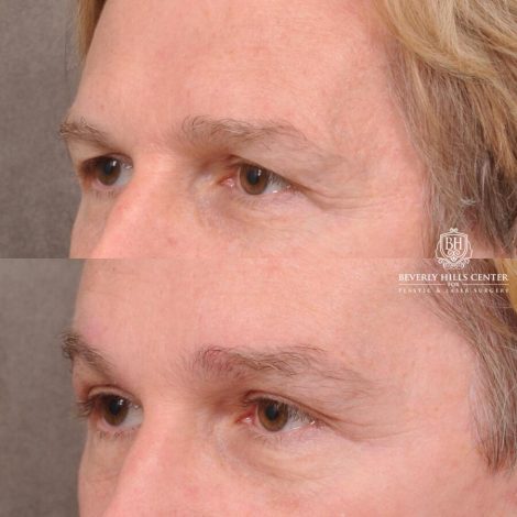 Beverly Hills Center Female Patient Before and After Brow Lift