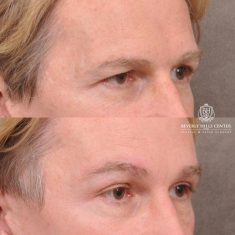 Beverly Hills Center Female Patient Before and After Brow Lift