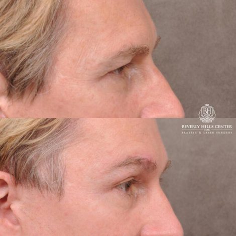 Beverly Hills Center Female Patient Before and After Brow Lift