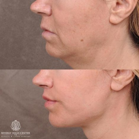 Beverly Hills Center Female Patient Before and After AuraLyft with TCA Peel and Lip Lift Procedure