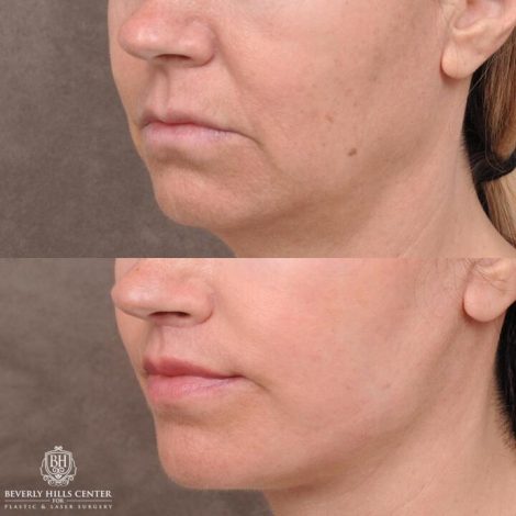 Beverly Hills Center Female Patient Before and After AuraLyft with TCA Peel and Lip Lift Procedure