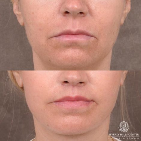 Beverly Hills Center Female Patient Before and After AuraLyft with TCA Peel and Lip Lift Procedure