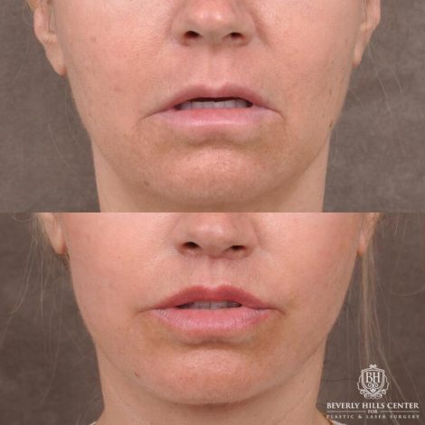 Beverly Hills Center Female Patient Before and After AuraLyft with TCA Peel and Lip Lift Procedure