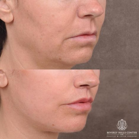 Beverly Hills Center Female Patient Before and After AuraLyft with TCA Peel and Lip Lift Procedure