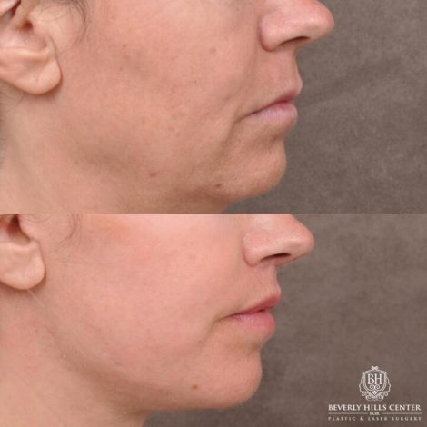 Beverly Hills Center Female Patient Before and After AuraLyft with TCA Peel and Lip Lift Procedure