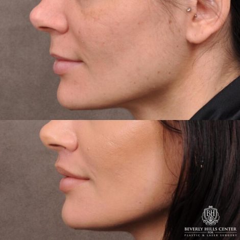 Beverly Hills Center Female Patient Before and After Lip Lift Procedure