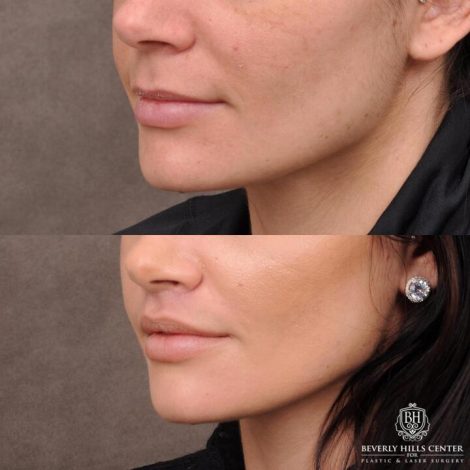 Beverly Hills Center Female Patient Before and After Lip Lift Procedure