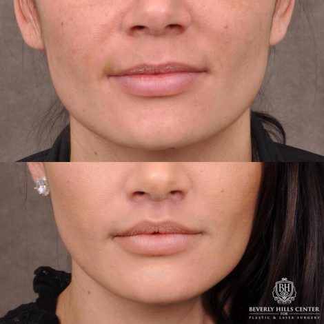 Beverly Hills Center Female Patient Before and After Lip Lift Procedure