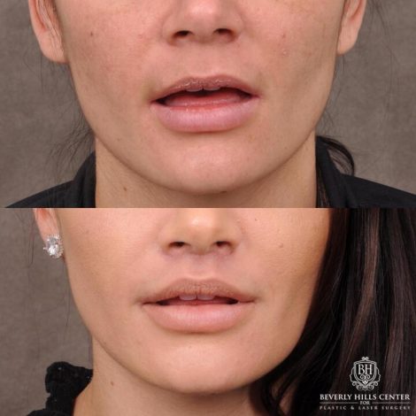 Beverly Hills Center Female Patient Before and After Lip Lift Procedure