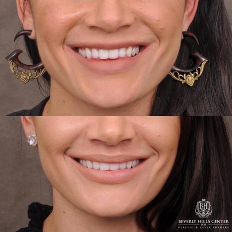Beverly Hills Center Female Patient Before and After Lip Lift Procedure