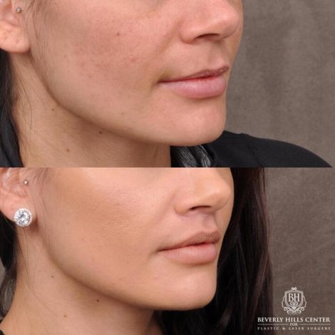 Beverly Hills Center Female Patient Before and After Lip Lift Procedure